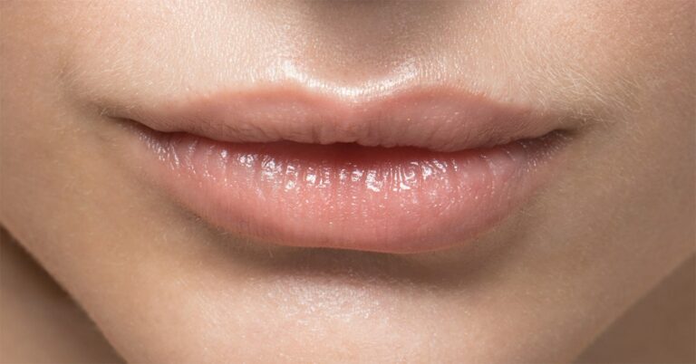 Lippen aufspritzen | vorher – nachher | ohne Reue